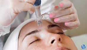 Medical Skin Needling and Radio-frequency Treatment