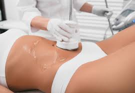 Cavitation & Radiofrequency Sculpting